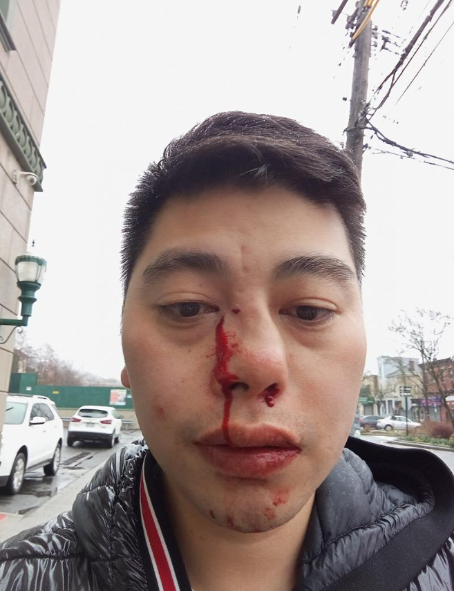 怒了！36岁华人遭一元店黑人员工嫌弃英文差，被殴打至颅内出血！ ... ...