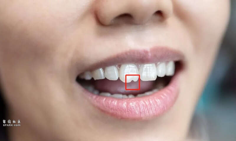 门牙前的“豁”真是嗑瓜子惹的祸?多年的困惑解开了(图)