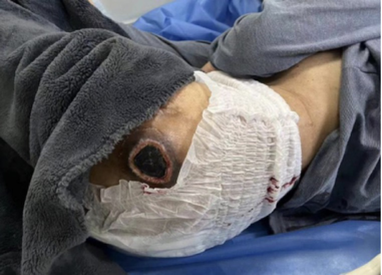 急诊转入全身溃烂患者 医生:这病比教科书还全(图)