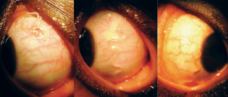慎点!男子感觉眼里有东西 医生拉出罗阿罗阿丝虫(图)