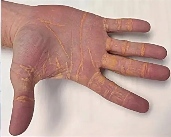 他每天吃3公斤黄油汉堡 胆固醇直接“渗”出手指(图)