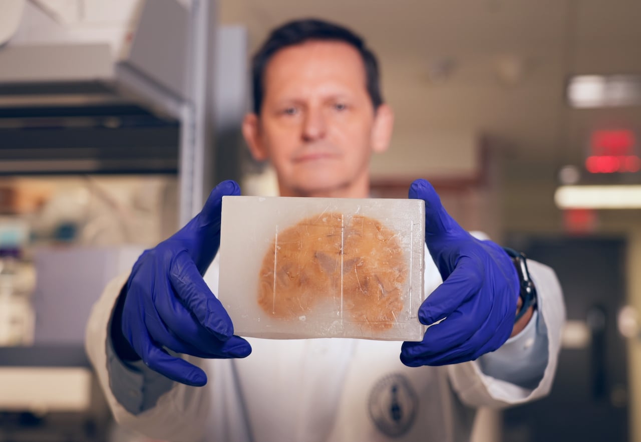 Neuropathologist Dr. Gabor Kovacs, from the University of Toronto's Krembil Brain Institute, holds up a donated human brain encased in paraffin wax.