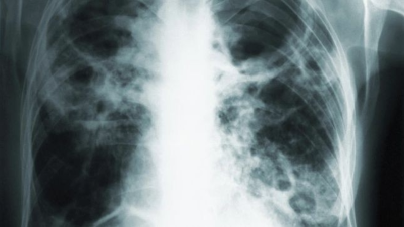 堪萨斯州爆发“美国史上规模最大”肺结核疫情(图)