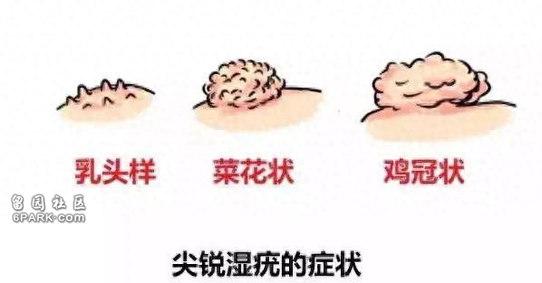 45岁男子生殖器长出“菜花” 在医院他懊悔不已(图)