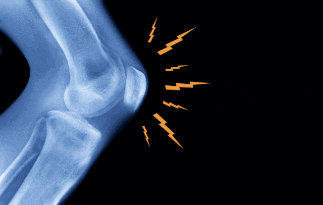 必须重视!膝盖一动就咔咔响,可能与这4种病有关(组图)