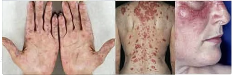 女子患红斑狼疮赴国外“安乐死”该如何看待?(图)