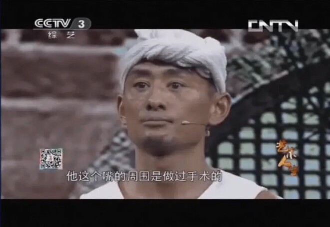 还记得《星光大道》阿宝吗？疑似被烧伤面容大变（配图3）