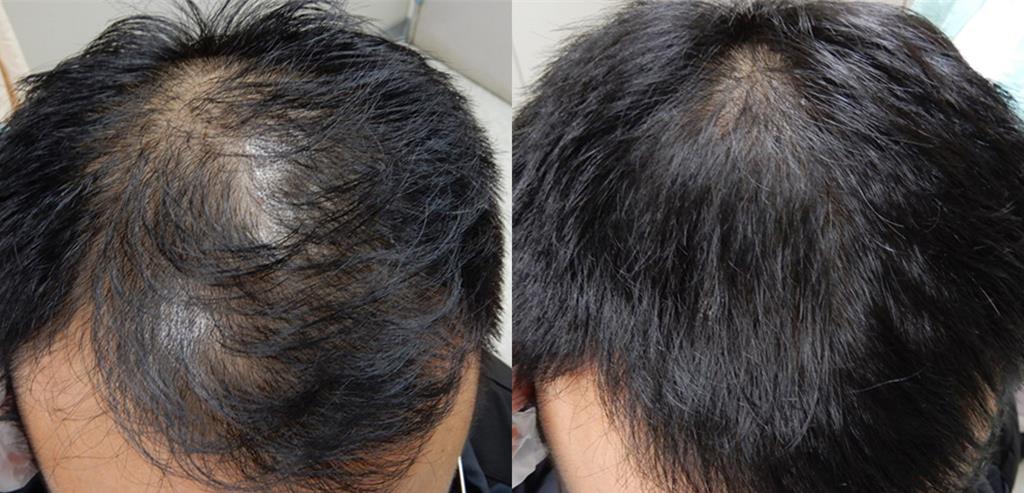 台中一名男子因為身體缺鋅大量掉髮，攝取牡蠣、生蠔、蚵仔、牛肉、南瓜子及其他含鋅等6大類食物後，順利長回原本的髮量。（圖／澄清醫院中港院區提供）