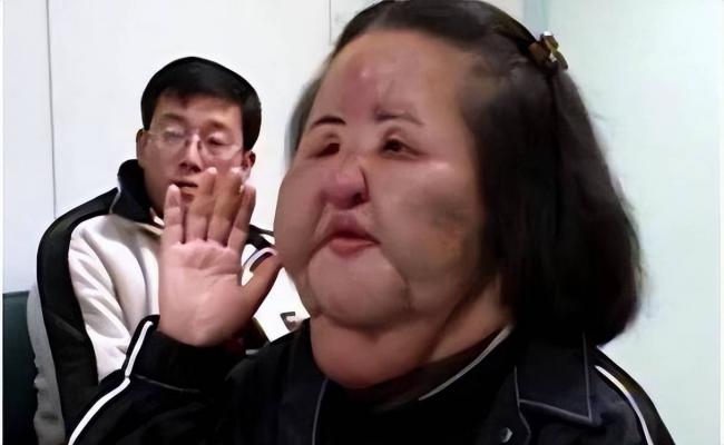 女星整容下狠手 头部取出一公斤液体物质