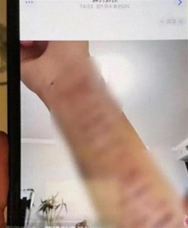 她被注射不明物：三年没来例假 没一人为她说话（配图3）