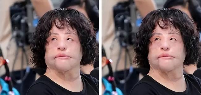 女星整容下狠手 头部取出一公斤液体物质