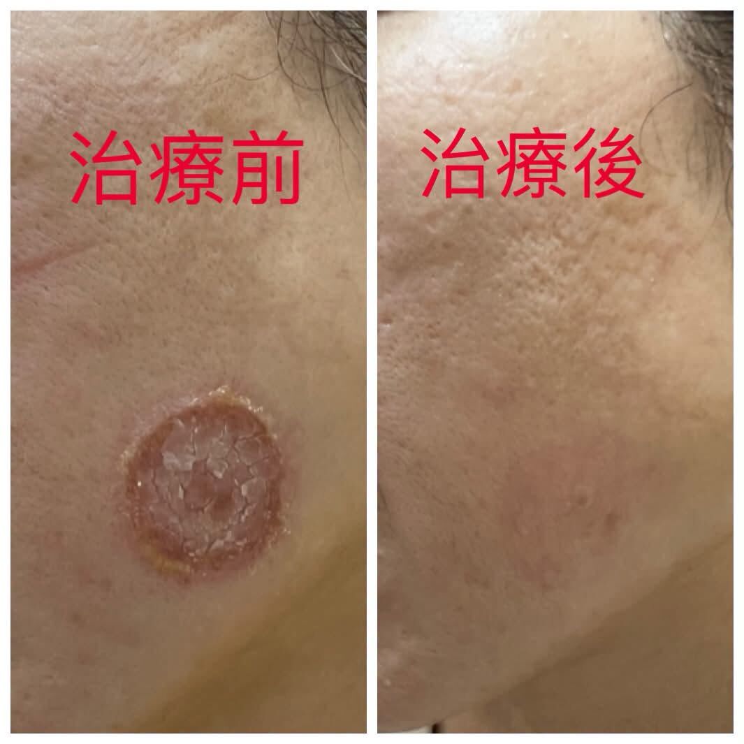 ▲▼妹子臉癢1週變「50元結痂大餅」！擦藥沒用　醫警告：傳染力超強。（圖／吳仁欽醫師授權提供，未經同意請勿任意翻攝）