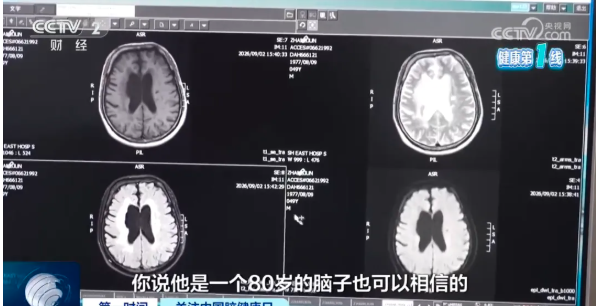 49岁男大脑萎缩如80岁 六大伤脑行为你每天在做