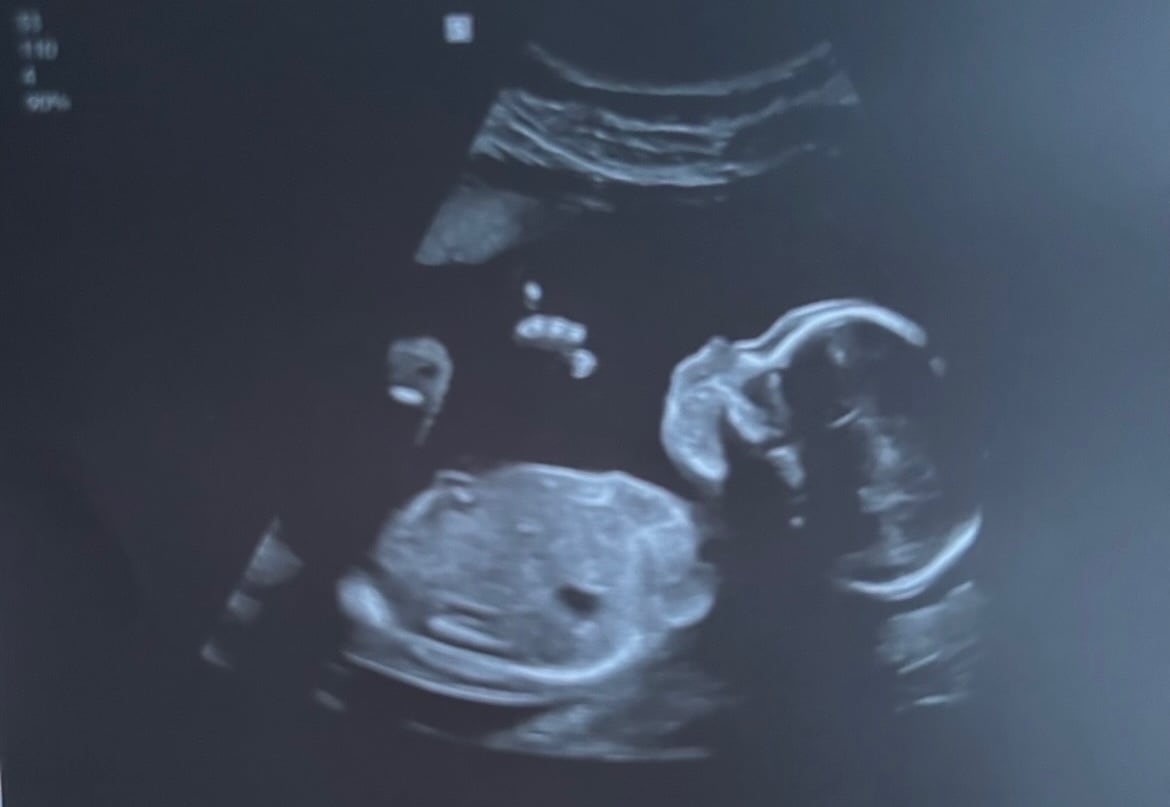 An ultrasound of a baby