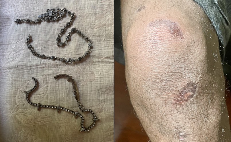 Photos shared with CityNews show damage to two necklaces and scrapes to the man's knee after an interaction with York Region Transit personnel. 